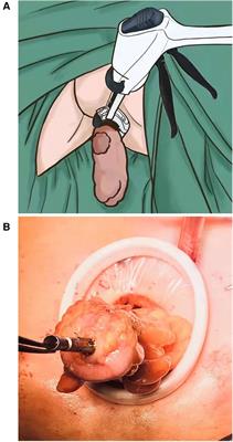 Integration of prolapsing technique and one-stitch method of ileostomy during laparoscopic low anterior resection for rectal cancer: a retrospective study